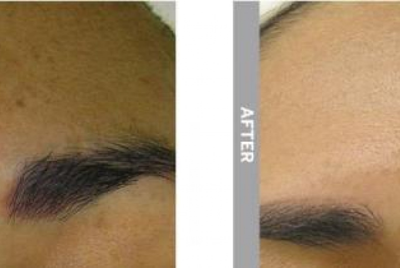  Hydrafacial / HYDRAFACIAL - foto