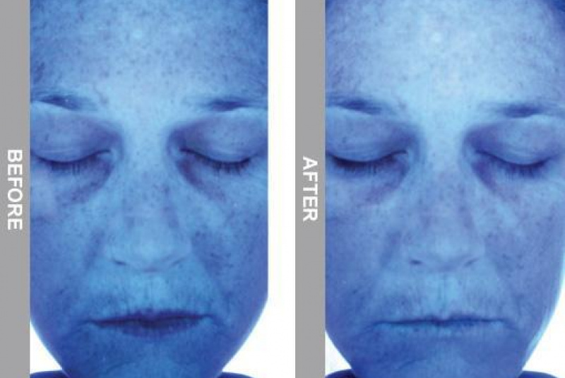  Hydrafacial / HYDRAFACIAL - foto