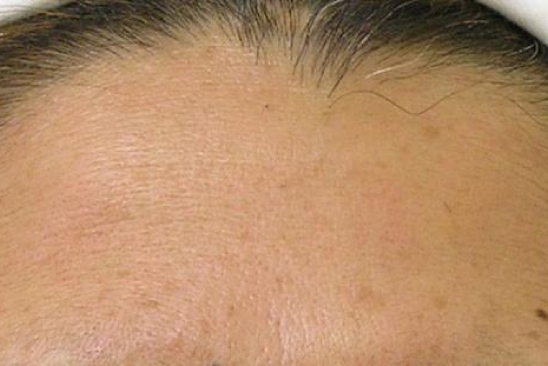  Hydrafacial / HYDRAFACIAL - foto