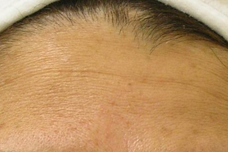  Hydrafacial / HYDRAFACIAL - foto