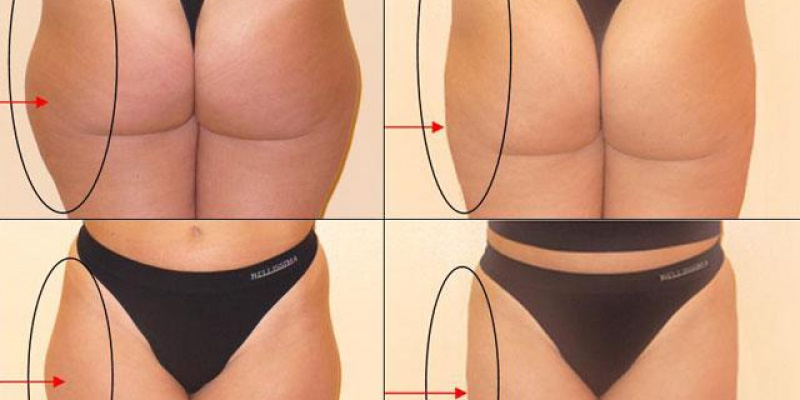  Trvalé odstránenie tuku - Bodyka / Trvalé odstránenie tuku - Bodyka - foto