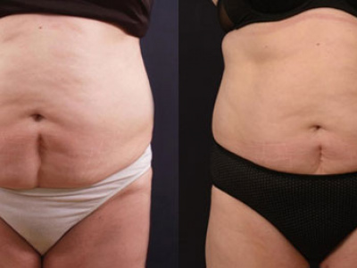 NEINVAZÍVNE ODSTRÁNENIE TUKU