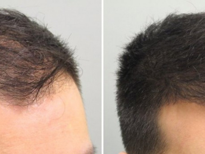 VLASOVÁ MEZOTERAPIA